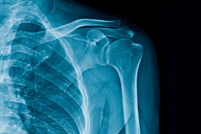 X-ray of a human shoulder joint